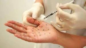 Iperidrosi Iperidrosi