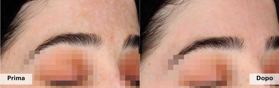 trattamento Melanstop