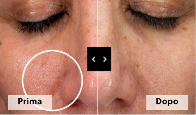 trattamento Meso Antioxid