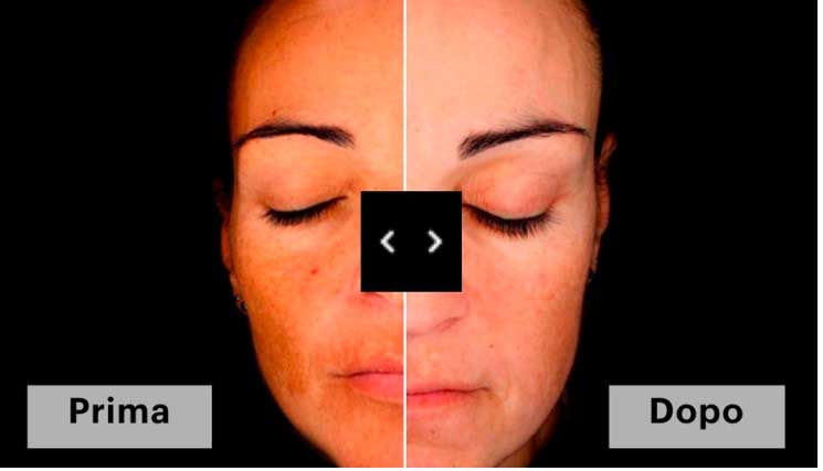 trattamento Meso Photoaging