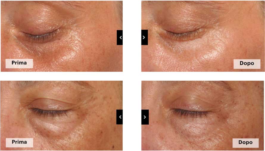 trattamento Mesoeye Anti-Age
