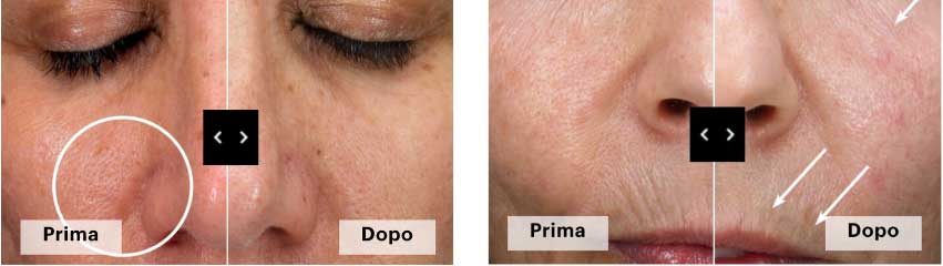 trattamento Skin Retin