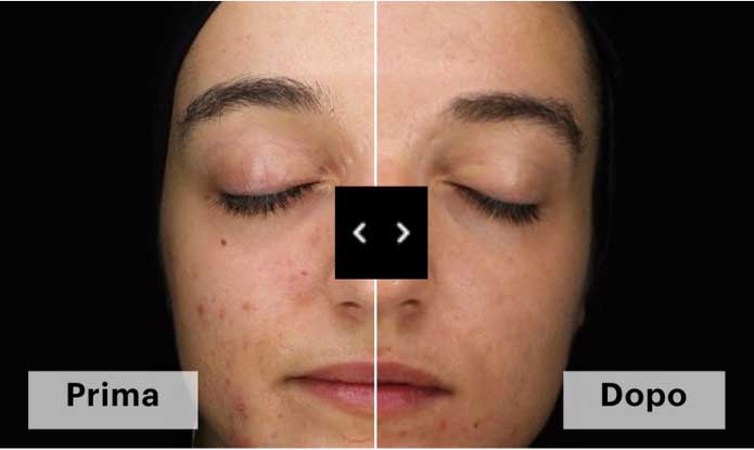 trattamento viso Blemiskin Acne