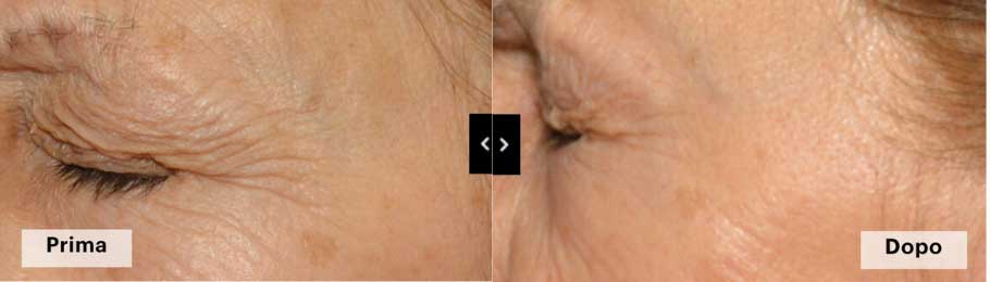 trattamento viso Mesotox